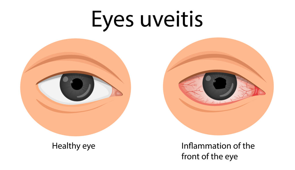 Illustration showing inflammation from uveitis