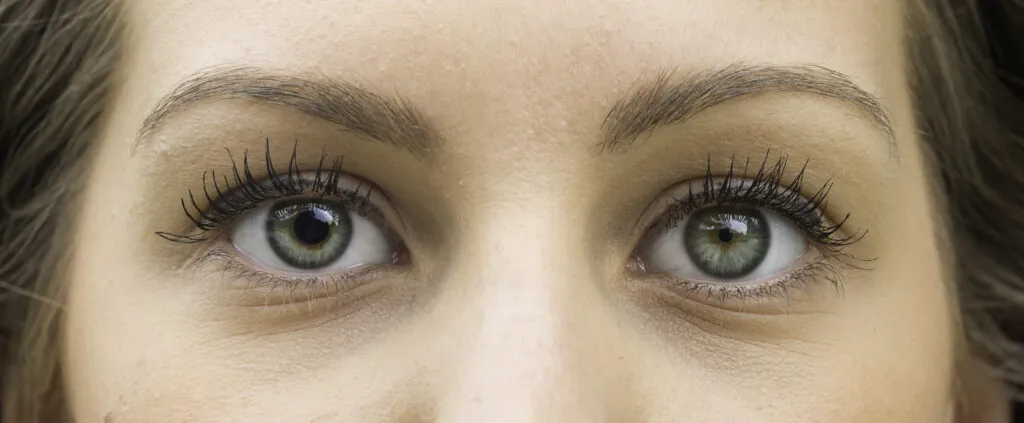 Close-up of a person’s eyes with one pupil slightly larger
