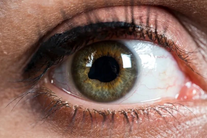 Eye close-up with irregular pupil shape simulating tadpole pupil